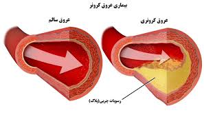 بیماری عروق کرونر (ppt) 128 اسلاید